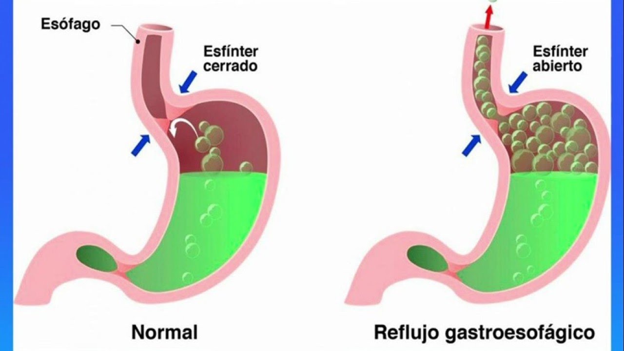 Descubre cómo el ejercicio puede provocar el síndrome gastrointestinal en ¡solo 70 caracteres!