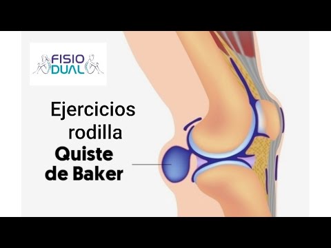 Descubre efectivos ejercicios para eliminar el quiste de Baker de forma natural