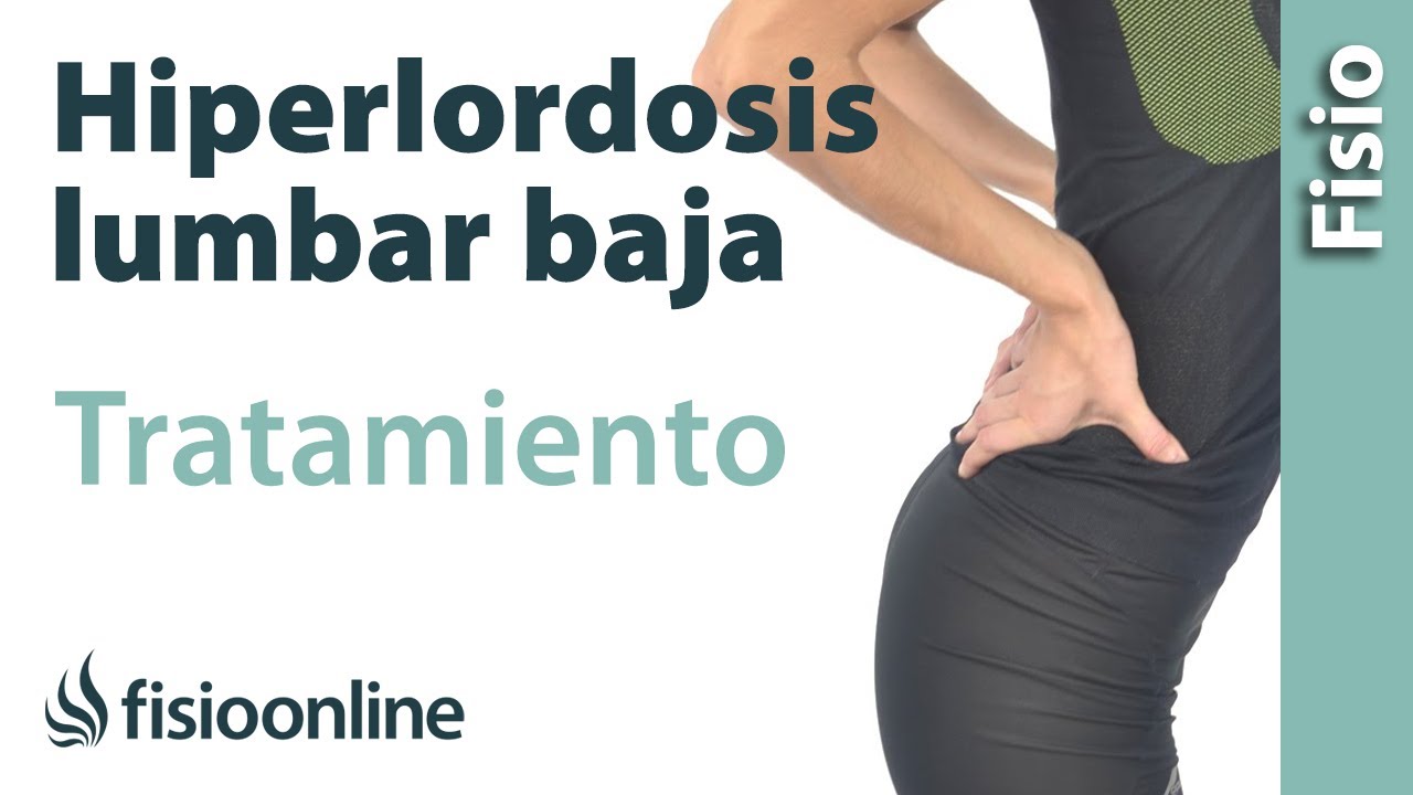 Descubre La Hiperlordosis Lumbar Qu Es Y C Mo Afecta Nuestra Salud Gu Afisio Es