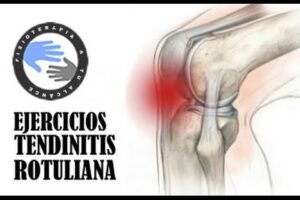 Rehabilitación para la Tendinitis Rotuliana